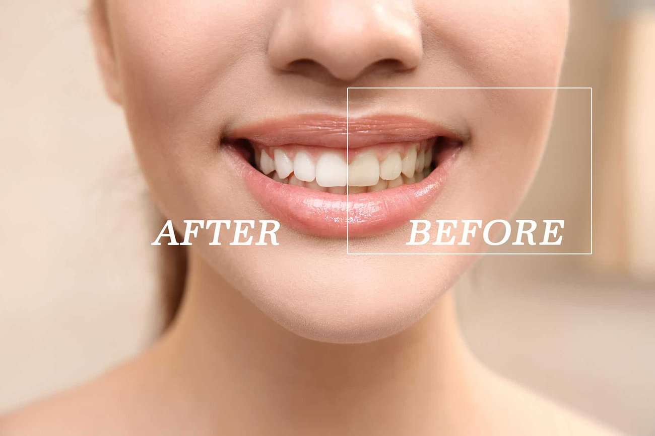 How Can You Maintain a Consistent Smile Shade with Crowns Banbury?