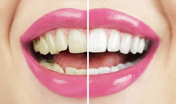 What Makes Ultima White Teeth Whitening Different Banbury