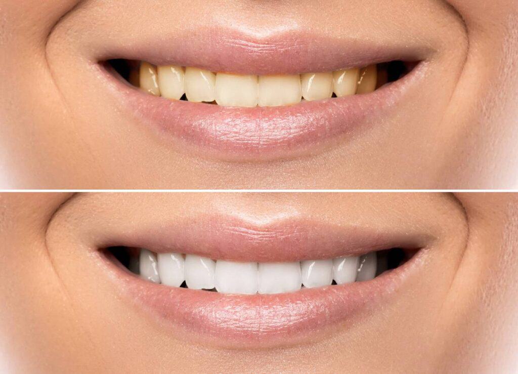 How Can You Protect Your White Smile as a Coffee Lover Banbury?