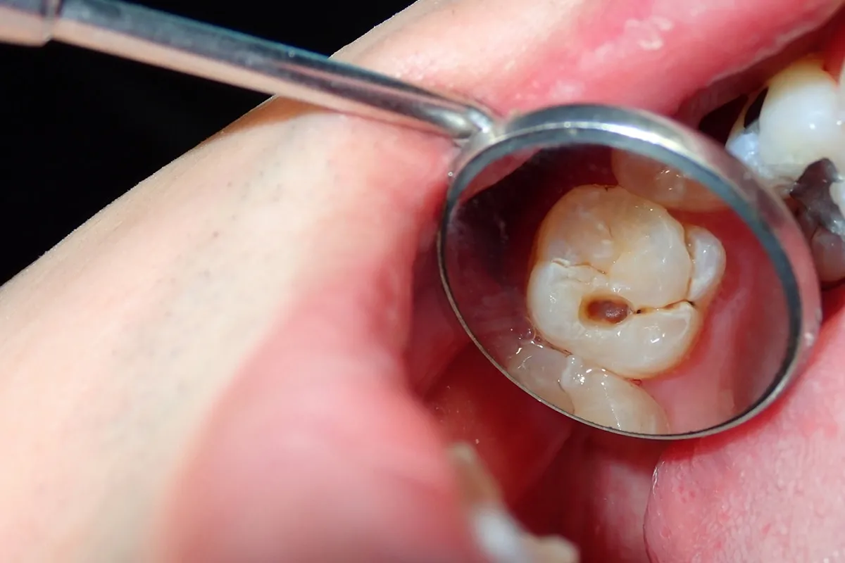 Why Do Teeth Crack? Common Causes to Know Banbury