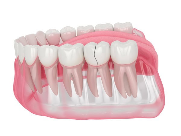 How Can You Manage Pain and Discomfort After a Root Canal Banbury?