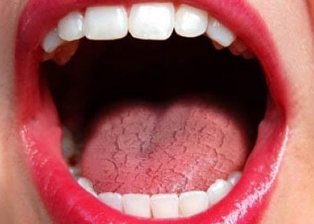 Common Causes of Dry Mouth (Xerostomia) Banbury