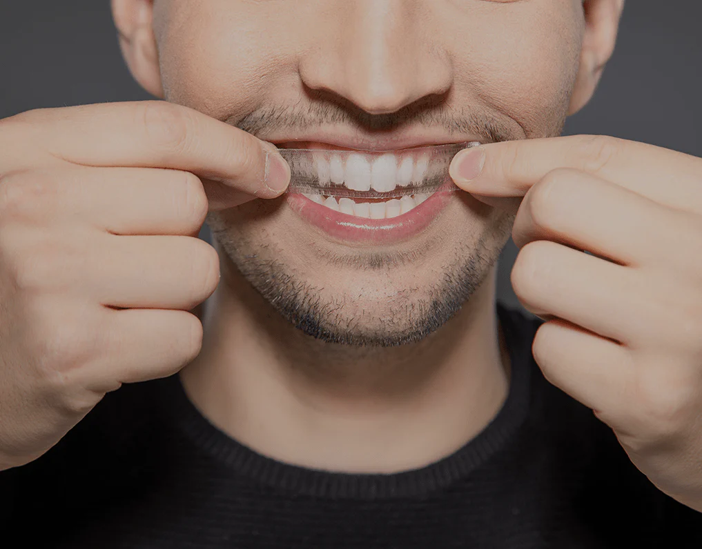 What to Consider Before Choosing a Teeth Whitening Option Banbury