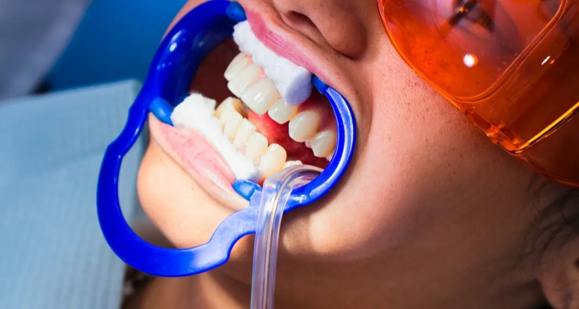 How Teeth Whitening Treatments Actually Work on Your Enamel Banbury