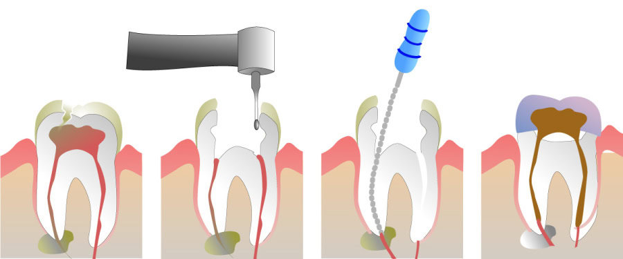 How Do You Properly Care for Your Teeth After a Root Canal Banbury