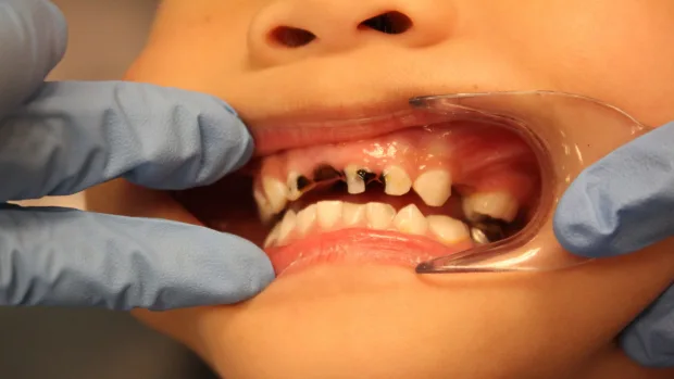 Which Foods and Drinks Cause the Most Damage to Young Smiles Banbury?