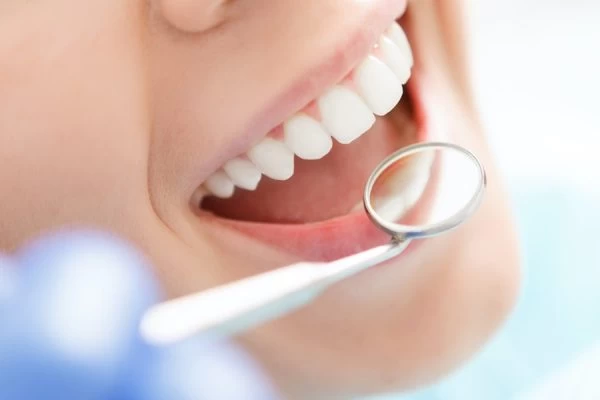 Preventing White Spots on Teeth Banbury