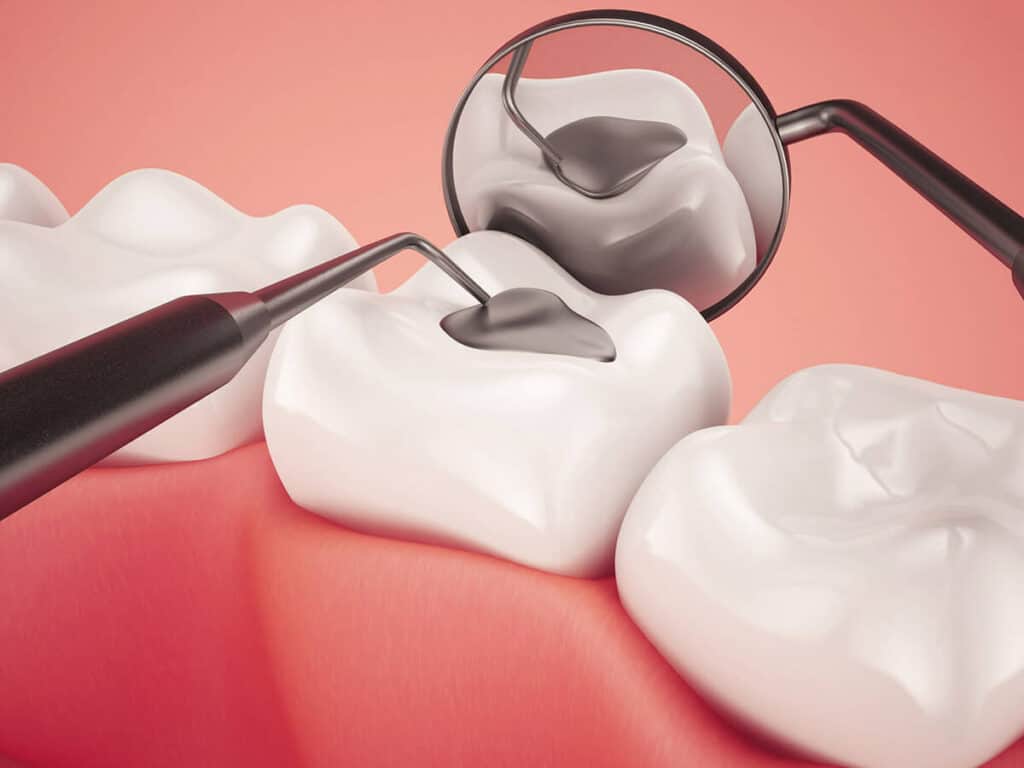 Fighting Cavities and Plaque Buildup Banbury