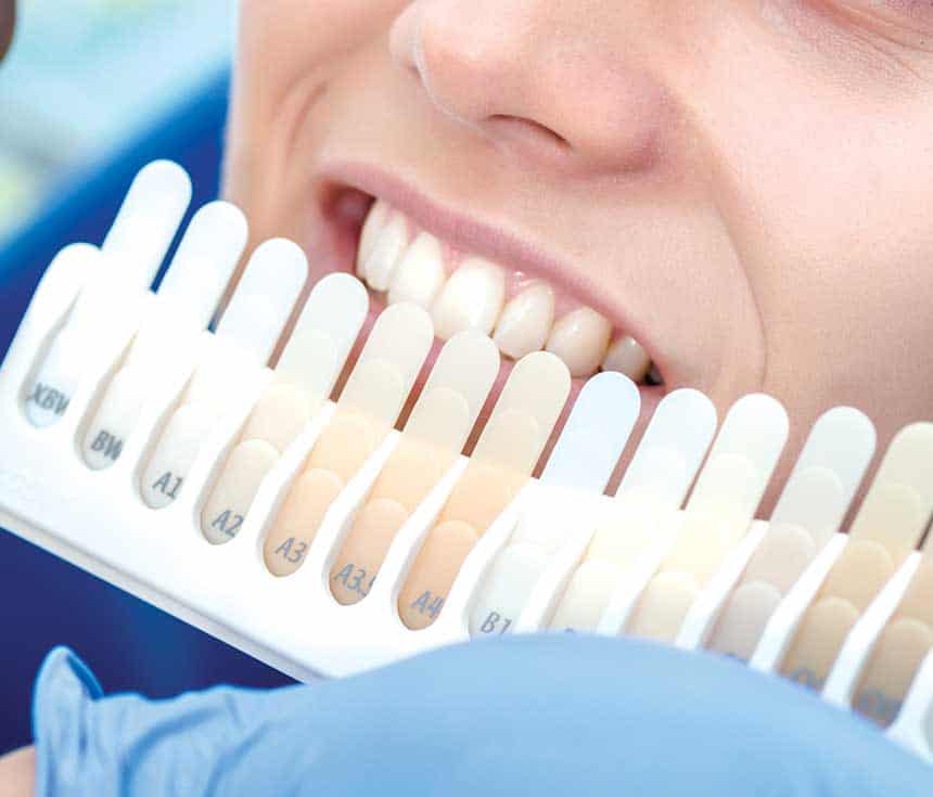 Professional vs At-Home Whitening: What You Need to Know Banbury