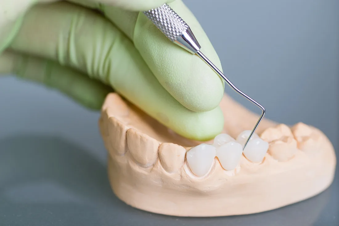 What Are the Different Types of Dental Crowns Available Banbury?