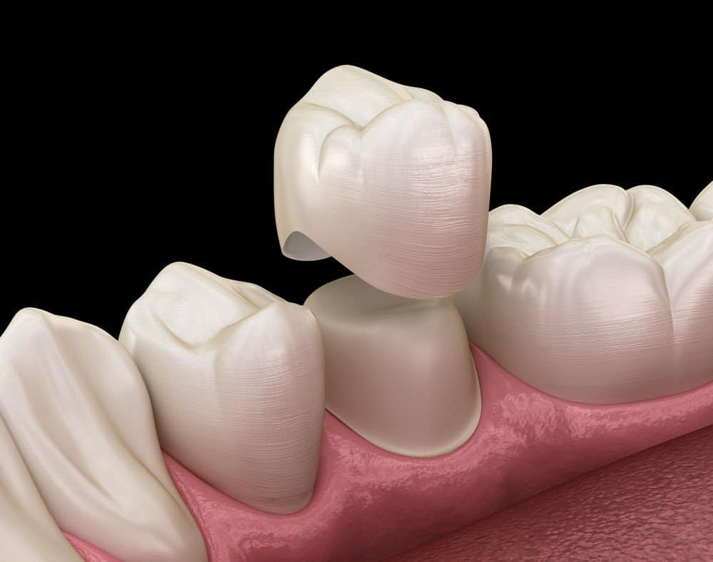 Teeth Whitening: Separating Facts from Fiction Banbury