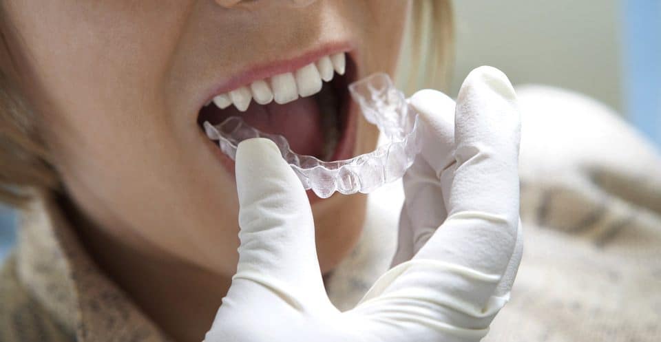 Can Bruxism Affect Your Sleep Quality Banbury