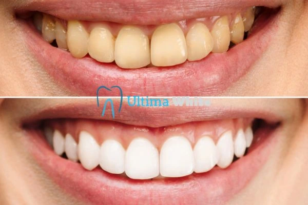 Oral Care Tips for Current and Former Smokers Banbury