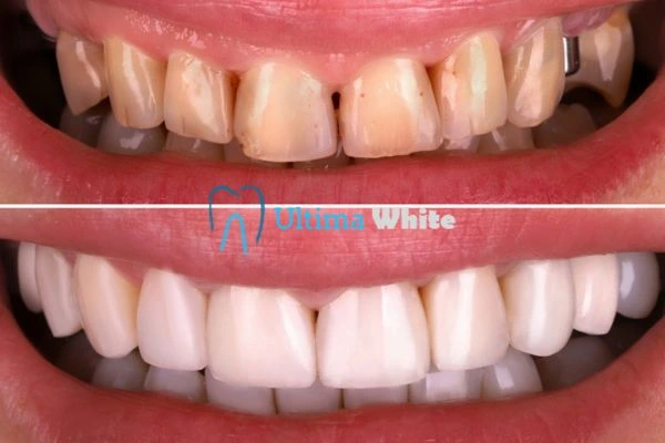 What Makes Instant Teeth Whitening Treatments So Popular Banbury?