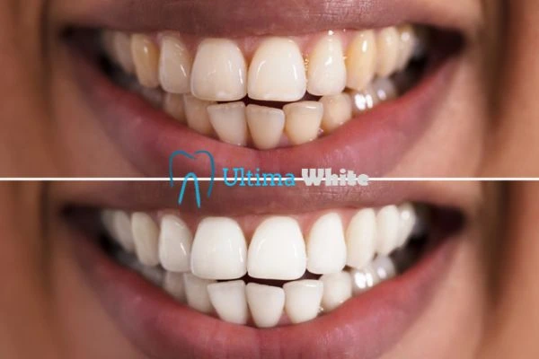 Aftercare Tips to Maintain Your New Smile Banbury